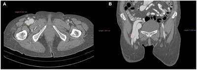 Case Report: Gigantic Arteriovenous Femoral Fistula Following Cardiac Artery Catheterization